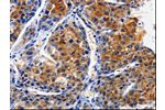 The image on the left is immunohistochemistry of paraffin-embedded Human liver cancer tissue using CSB-PA641512(CLCA4 Antibody) at dilution 1/10, on the right is treated with fusion protein. (Original magnification: 