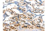 The image on the left is immunohistochemistry of paraffin-embedded Human thyroid cancer tissue using CSB-PA642427(A4GALT Antibody) at dilution 1/30, on the right is treated with synthetic peptide. (Original magnification: 