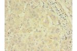 Immunohistochemistry of paraffin-embedded human liver cancer using CSB-PA643574LA01HU at dilution of 1:100
