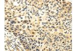 The image on the left is immunohistochemistry of paraffin-embedded Human esophagus cancer tissue using CSB-PA643784(CDKN1A Antibody) at dilution 1/20, on the right is treated with fusion protein. (Original magnification: 