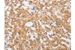 The image on the left is immunohistochemistry of paraffin-embedded Human thyroid cancer tissue using CSB-PA644111(CDKN2C Antibody) at dilution 1/25, on the right is treated with fusion protein. (Original magnification: 