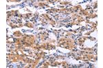 The image on the left is immunohistochemistry of paraffin-embedded Human thyroid cancer tissue using CSB-PA644588(ESPL1 Antibody) at dilution 1/40, on the right is treated with synthetic peptide. (Original magnification: 