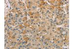 The image on the left is immunohistochemistry of paraffin-embedded Human liver cancer tissue using CSB-PA646140(CENPF Antibody) at dilution 1/40, on the right is treated with synthetic peptide. (Original magnification: 