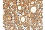 The image on the left is immunohistochemistry of paraffin-embedded Human thyroid cancer tissue using CSB-PA646965(CYP7A1 Antibody) at dilution 1/30, on the right is treated with synthetic peptide. (Original magnification: 