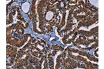 The image on the left is immunohistochemistry of paraffin-embedded Human thyroid cancer tissue using CSB-PA648744(ADRBK2 Antibody) at dilution 1/40, on the right is treated with fusion protein. (Original magnification: 