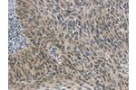 The image on the left is immunohistochemistry of paraffin-embedded Human cervical cancer tissue using CSB-PA652205(FOXF1 Antibody) at dilution 1/25, on the right is treated with synthetic peptide. (Original magnification: 