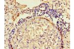 Immunohistochemistry of paraffin-embedded human lung cancer using CSB-PA653477LA01HU at dilution of 1:100