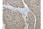 The image on the left is immunohistochemistry of paraffin-embedded Human liver cancer tissue using CSB-PA654216(ADHFE1 Antibody) at dilution 1/25, on the right is treated with synthetic peptide. (Original magnification: 