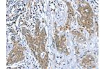 The image on the left is immunohistochemistry of paraffin-embedded Human cervical cancer tissue using CSB-PA657435(DSTYK Antibody) at dilution 1/40, on the right is treated with fusion protein. (Original magnification: 