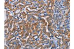 The image on the left is immunohistochemistry of paraffin-embedded Human thyroid cancer tissue using CSB-PA657688(ALG12 Antibody) at dilution 1/20, on the right is treated with fusion protein. (Original magnification: 