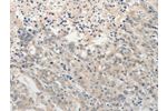 The image on the left is immunohistochemistry of paraffin-embedded Human gastic cancer tissue using CSB-PA657730(ADAMTS6 Antibody) at dilution 1/15, on the right is treated with synthetic peptide. (Original magnification: 