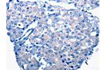 The image on the left is immunohistochemistry of paraffin-embedded Human breast cancer tissue using CSB-PA662351(CCL2 Antibody) at dilution 1/50, on the right is treated with synthetic peptide. (Original magnification: 