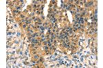 The image on the left is immunohistochemistry of paraffin-embedded Human breast cancer tissue using CSB-PA663869(DHCR24 Antibody) at dilution 1/35, on the right is treated with fusion protein. (Original magnification: 