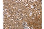 The image on the left is immunohistochemistry of paraffin-embedded Human cervical cancer tissue using CSB-PA664930(FHL2 Antibody) at dilution 1/40, on the right is treated with fusion protein. (Original magnification: 