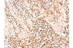 The image on the left is immunohistochemistry of paraffin-embedded Human gastic cancer tissue using CSB-PA665979(AMD1 Antibody) at dilution 1/20, on the right is treated with synthetic peptide. (Original magnification: 