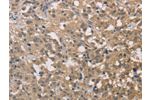 The image on the left is immunohistochemistry of paraffin-embedded Human thyroid cancer tissue using CSB-PA671890(DSTN Antibody) at dilution 1/30, on the right is treated with fusion protein. (Original magnification: 