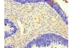 Immunohistochemistry of paraffin-embedded human ovarian cancer using CSB-PA674579LA01HU at dilution of 1:100