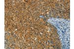 The image on the left is immunohistochemistry of paraffin-embedded Human cervical cancer tissue using CSB-PA674975(DIRAS1 Antibody) at dilution 1/30, on the right is treated with synthetic peptide. (Original magnification: 