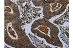The image on the left is immunohistochemistry of paraffin-embedded Human colon cancer tissue using CSB-PA676168(GLUL Antibody) at dilution 1/60, on the right is treated with fusion protein. (Original magnification: 