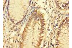 Immunohistochemistry of paraffin-embedded human colon cancer using CSB-PA677719LA01HU at dilution 1:100