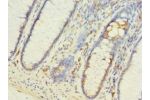 Immunohistochemistry of paraffin-embedded human colon cancer using CSB-PA679703LA01HU at dilution of 1:100
