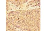 Immunohistochemistry of paraffin-embedded human ovarian cancer using CSB-PA681515LA01HU at dilution 1:100