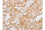 The image on the left is immunohistochemistry of paraffin-embedded Human thyroid cancer tissue using CSB-PA687184(CDKN2AIP Antibody) at dilution 1/40, on the right is treated with fusion protein. (Original magnification: 