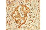 Immunohistochemistry of paraffin-embedded human pancreatic cancer using CSB-PA687502LA01HU at dilution of 1:100