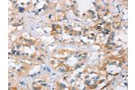The image on the left is immunohistochemistry of paraffin-embedded Human thyroid cancer tissue using CSB-PA687646(BCAS4 Antibody) at dilution 1/25, on the right is treated with synthetic peptide. (Original magnification: 