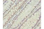 Immunohistochemistry of paraffin-embedded human colon cancer using CSB-PA689332LA01HU at dilution of 1:100