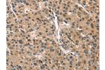 The image on the left is immunohistochemistry of paraffin-embedded Human liver cancer tissue using CSB-PA691668(CRIM1 Antibody) at dilution 1/25, on the right is treated with synthetic peptide. (Original magnification: 
