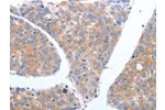 The image on the left is immunohistochemistry of paraffin-embedded Human breast cancer tissue using CSB-PA693066(GFRA4 Antibody) at dilution 1/40, on the right is treated with synthetic peptide. (Original magnification: 
