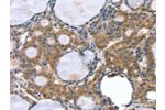 The image on the left is immunohistochemistry of paraffin-embedded Human thyroid cancer tissue using CSB-PA693151(GNAT3 Antibody) at dilution 1/35, on the right is treated with synthetic peptide. (Original magnification: 