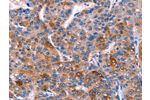 The image on the left is immunohistochemistry of paraffin-embedded Human liver cancer tissue using CSB-PA693441(DUSP13 Antibody) at dilution 1/60, on the right is treated with fusion protein. (Original magnification: 