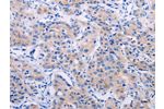 The image on the left is immunohistochemistry of paraffin-embedded Human lung cancer tissue using CSB-PA693559(AGT Antibody) at dilution 1/50, on the right is treated with synthetic peptide. (Original magnification: 