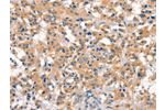 The image on the left is immunohistochemistry of paraffin-embedded Human thyroid cancer tissue using CSB-PA693996(EID3 Antibody) at dilution 1/15, on the right is treated with synthetic peptide. (Original magnification: 
