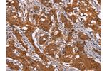 The image on the left is immunohistochemistry of paraffin-embedded Human gastic cancer tissue using CSB-PA694176(DCTN6 Antibody) at dilution 1/40, on the right is treated with fusion protein. (Original magnification: 