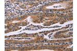 The image on the left is immunohistochemistry of paraffin-embedded Human gastic cancer tissue using CSB-PA694254(FAF1 Antibody) at dilution 1/40, on the right is treated with synthetic peptide. (Original magnification: 