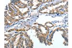 The image on the left is immunohistochemistry of paraffin-embedded Human thyroid cancer tissue using CSB-PA694467(ANGPT2 Antibody) at dilution 1/30, on the right is treated with fusion protein. (Original magnification: 