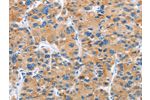 The image on the left is immunohistochemistry of paraffin-embedded Human liver cancer tissue using CSB-PA694579(DKK2 Antibody) at dilution 1/60, on the right is treated with fusion protein. (Original magnification: 