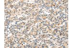 The image on the left is immunohistochemistry of paraffin-embedded Human liver cancer tissue using CSB-PA694660(DKK1 Antibody) at dilution 1/35, on the right is treated with synthetic peptide. (Original magnification: 