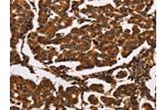 The image on the left is immunohistochemistry of paraffin-embedded Human breast cancer tissue using CSB-PA695075(ARSB Antibody) at dilution 1/50, on the right is treated with synthetic peptide. (Original magnification: 