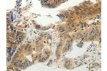 The image on the left is immunohistochemistry of paraffin-embedded Human colon cancer tissue using CSB-PA695128(CMTM7 Antibody) at dilution 1/30, on the right is treated with synthetic peptide. (Original magnification: 