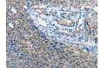 The image on the left is immunohistochemistry of paraffin-embedded Human cervical cancer tissue using CSB-PA695367(ATP1A1 Antibody) at dilution 1/35, on the right is treated with synthetic peptide. (Original magnification: 