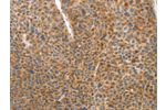 The image on the left is immunohistochemistry of paraffin-embedded Human liver cancer tissue using CSB-PA695560(DDX58 Antibody) at dilution 1/70, on the right is treated with synthetic peptide. (Original magnification: 