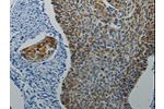 The image on the left is immunohistochemistry of paraffin-embedded Human cervical cancer tissue using CSB-PA695604(DRD4 Antibody) at dilution 1/5, on the right is treated with synthetic peptide. (Original magnification: 