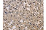 The image on the left is immunohistochemistry of paraffin-embedded Human thyroid cancer tissue using CSB-PA696333(DRG1 Antibody) at dilution 1/30, on the right is treated with fusion protein. (Original magnification: 