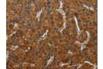 The image on the left is immunohistochemistry of paraffin-embedded Human liver cancer tissue using CSB-PA696449(CSH1 Antibody) at dilution 1/50, on the right is treated with fusion protein. (Original magnification: 