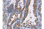 The image on the left is immunohistochemistry of paraffin-embedded Human gastic cancer tissue using CSB-PA696568(ANXA4 Antibody) at dilution 1/25, on the right is treated with fusion protein. (Original magnification: 