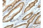The image on the left is immunohistochemistry of paraffin-embedded Human colon cancer tissue using CSB-PA696621(ASH2L Antibody) at dilution 1/50, on the right is treated with fusion protein. (Original magnification: 
